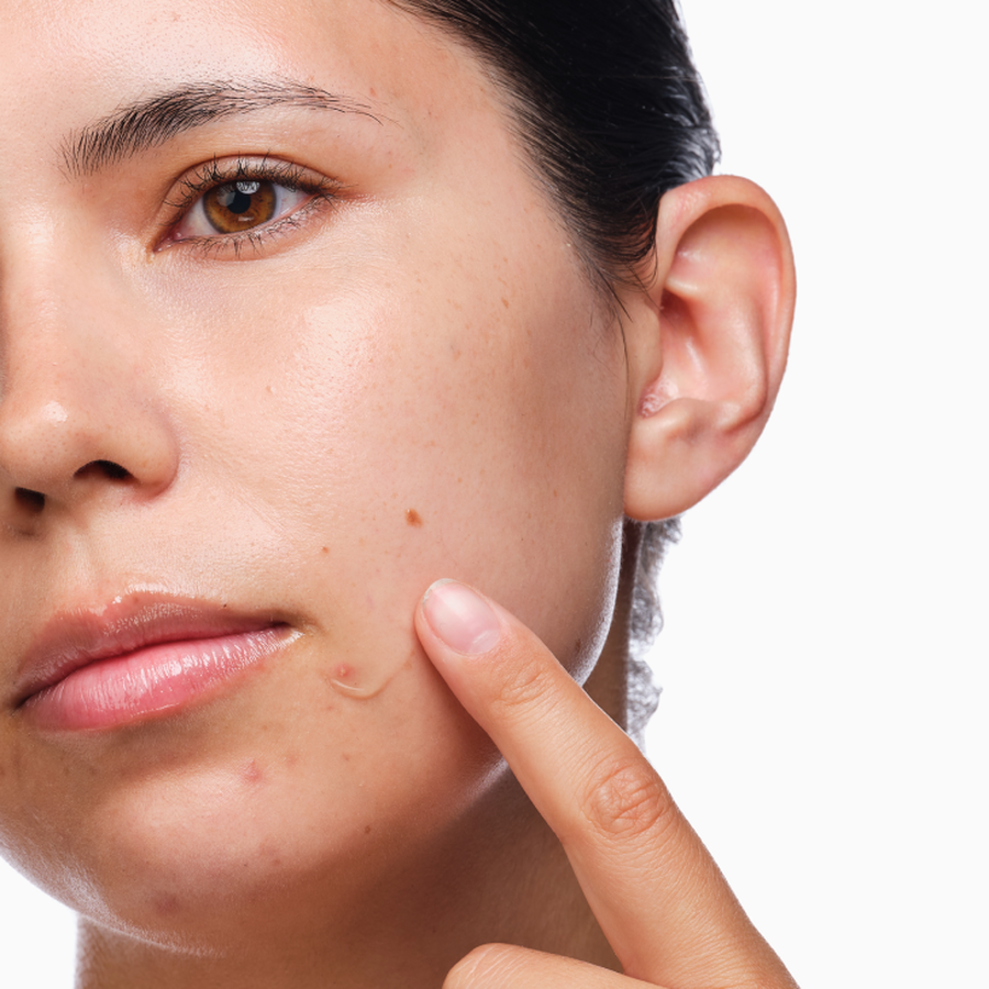 the-acne-set-b5 rdn-the-acne-set-application.png